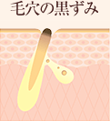 毛穴の黒ずみ